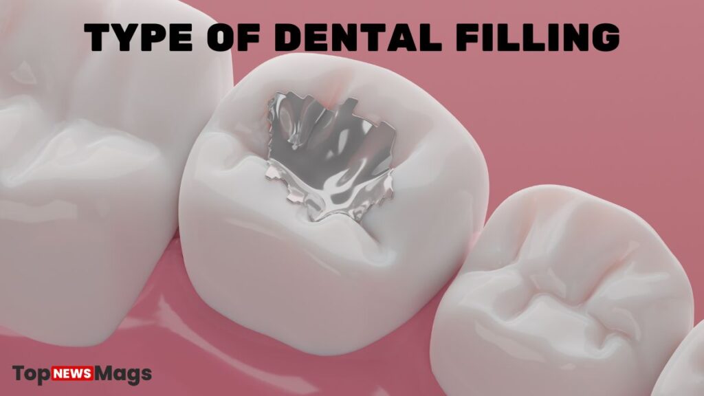 Types of Dental Filling